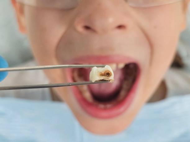 Best Emergency Tooth Extraction in Jermyn, PA